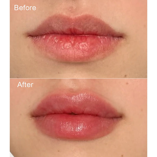 Plumpnest - The Injection-free Lip Volumizer